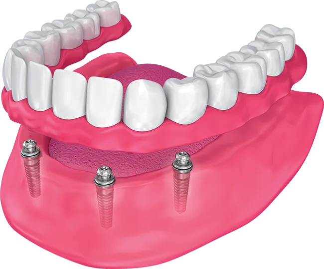 Image of snap-in dentures.