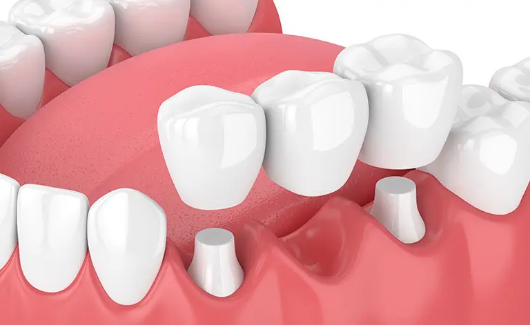 Illustration of a dental bridge.