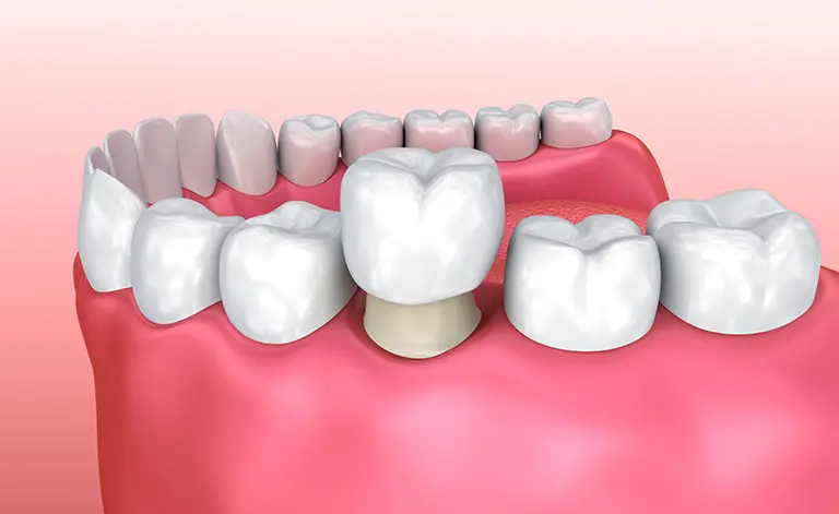 Illustration of a dental crown.