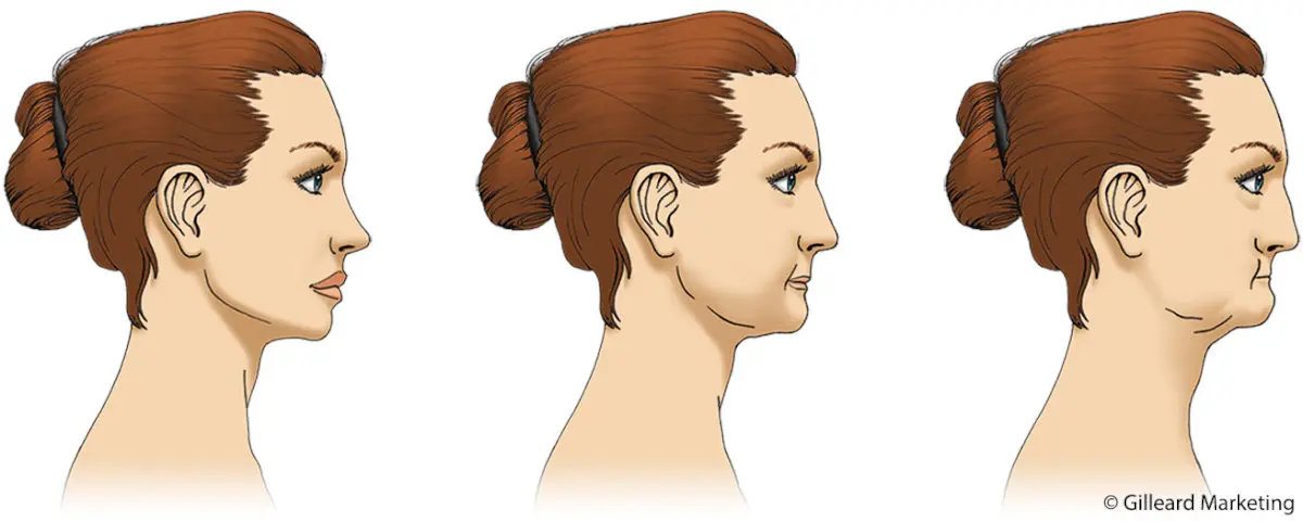 Illustration of a person losing jawbone.