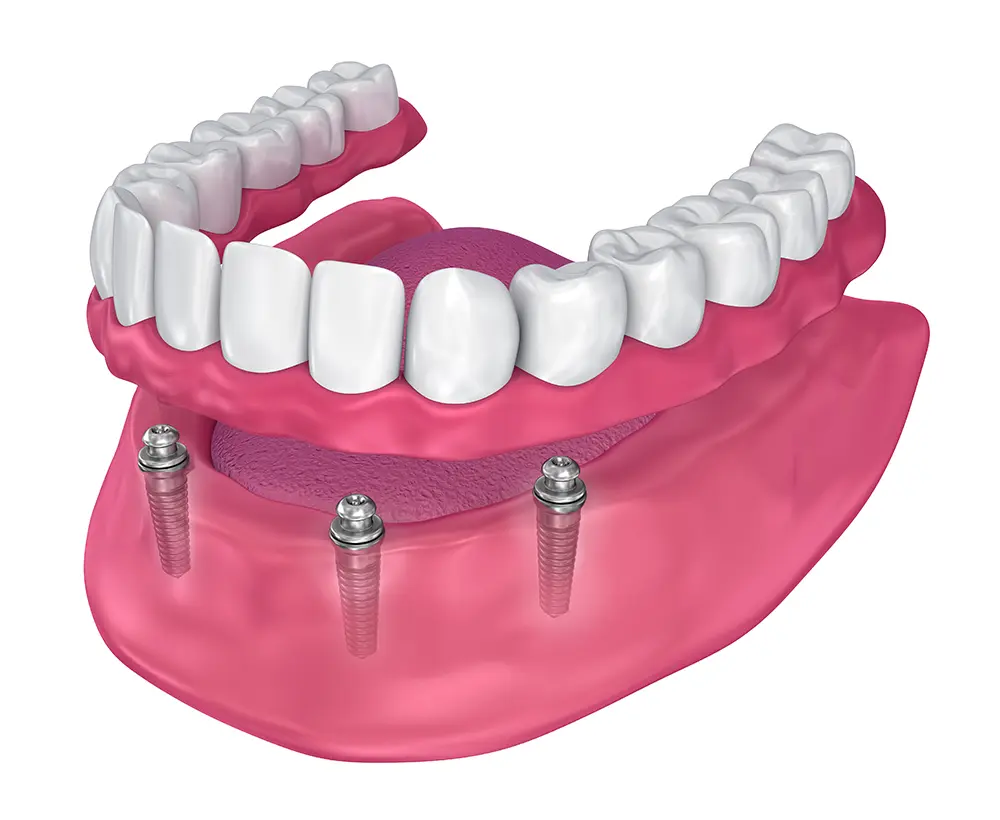 Illustration of a set of acrylic dentures supported by dental implants.