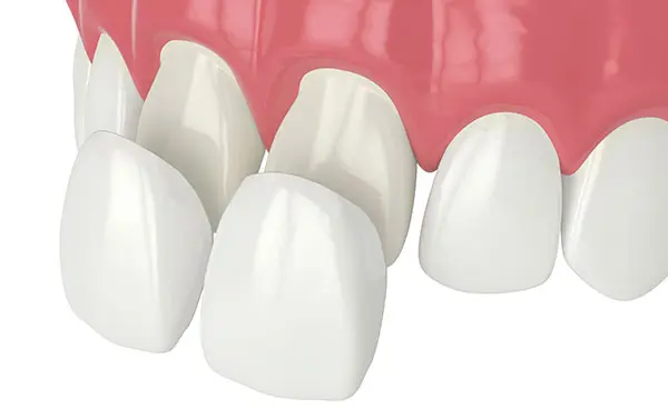 Illustration of no-prep veneers.