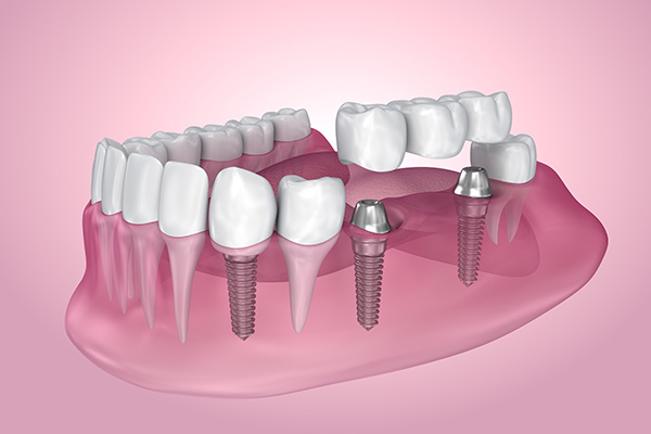 Dental implants in Lilburn