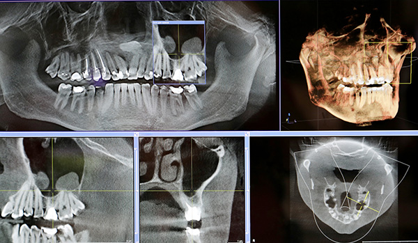 Best Dental Implants in Lilburn